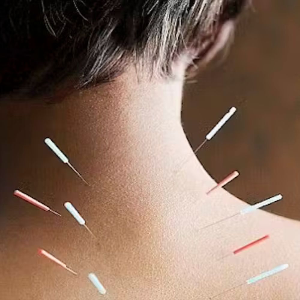 Dry Needling Therapy